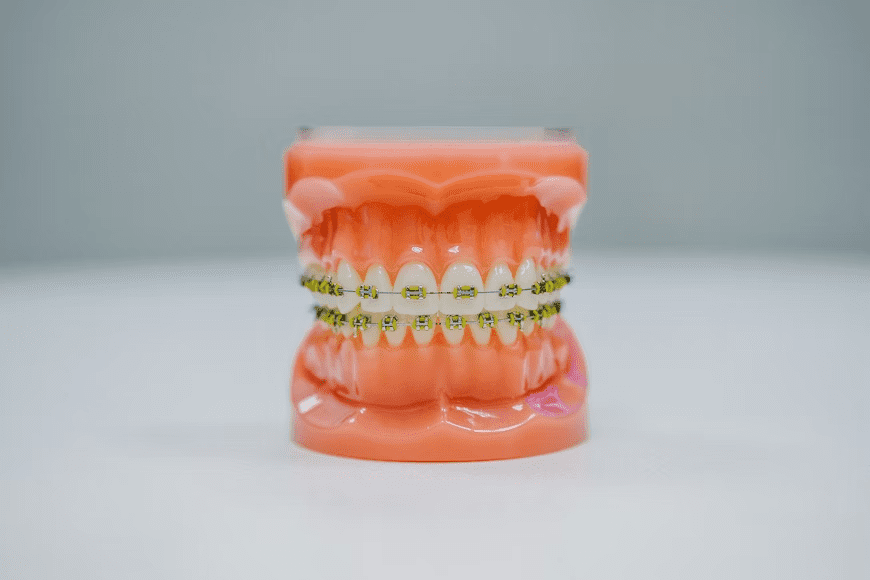 A model of teeth with braces on them.